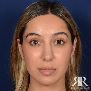 Female Rhinoplasty Before & After Gallery - Patient 916814 - Image 2