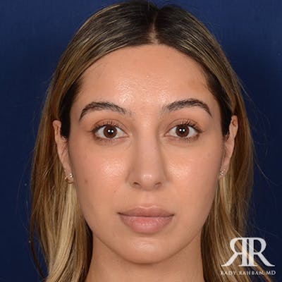 Female Rhinoplasty Before & After Gallery - Patient 916814 - Image 2