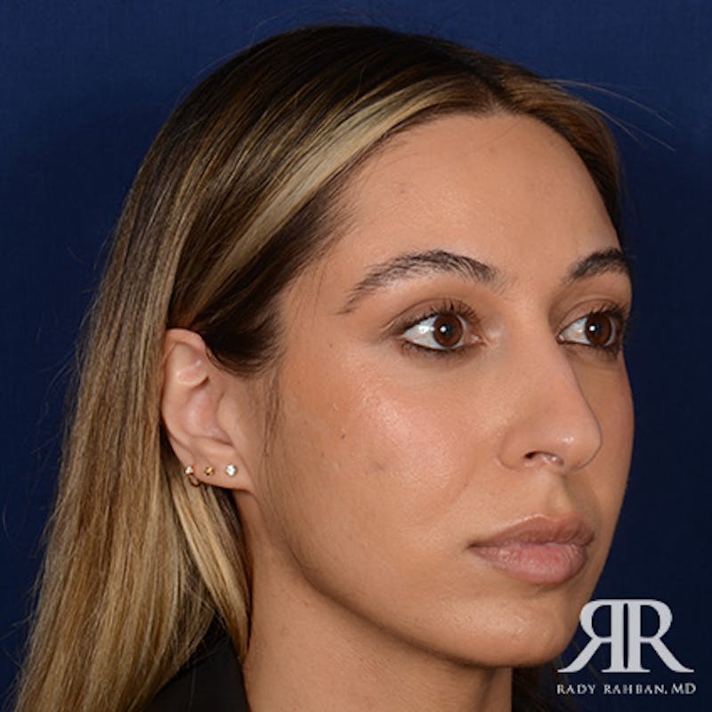 Female Rhinoplasty Before & After Gallery - Patient 916814 - Image 3
