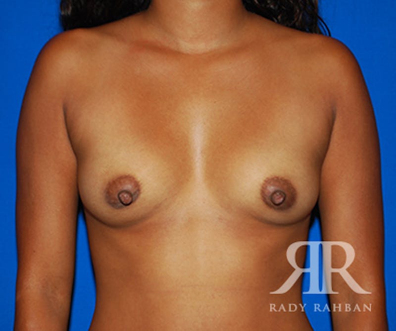 Breast Augmentation Before & After Gallery - Patient 169451 - Image 1