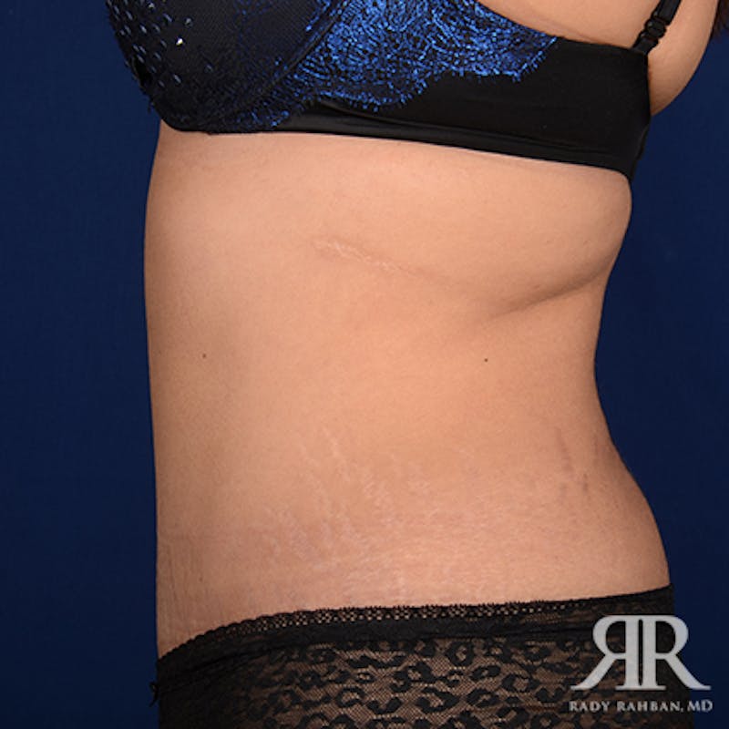 Tummy Tuck Before & After Gallery - Patient 390141 - Image 6