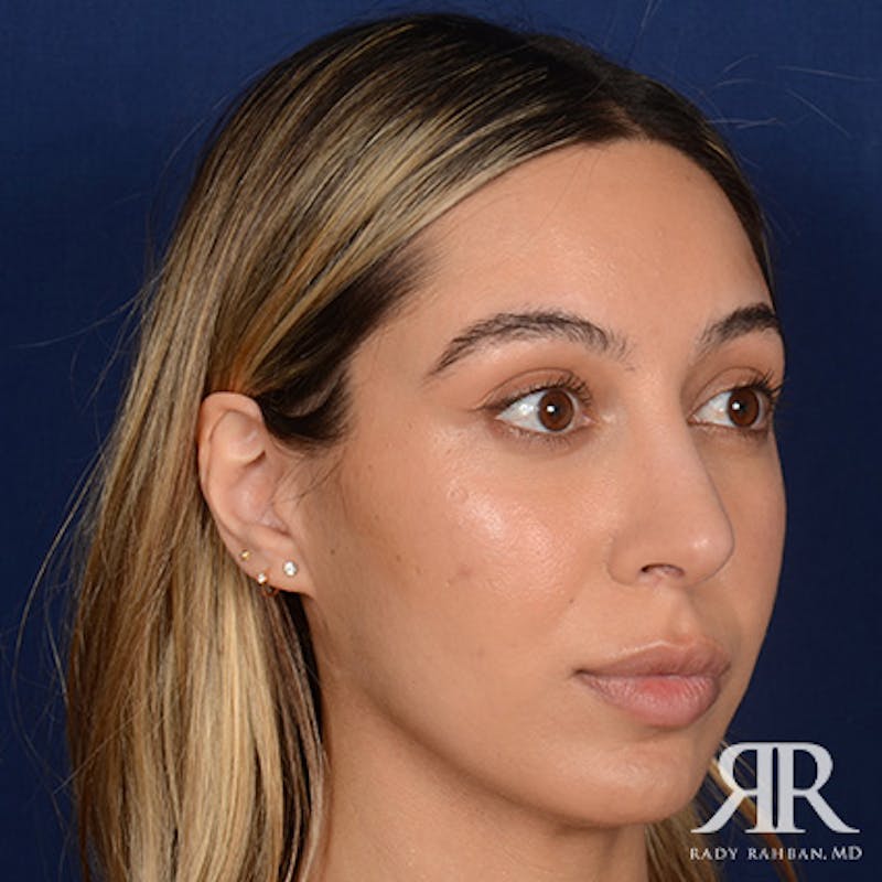 Female Rhinoplasty Before & After Gallery - Patient 916814 - Image 4