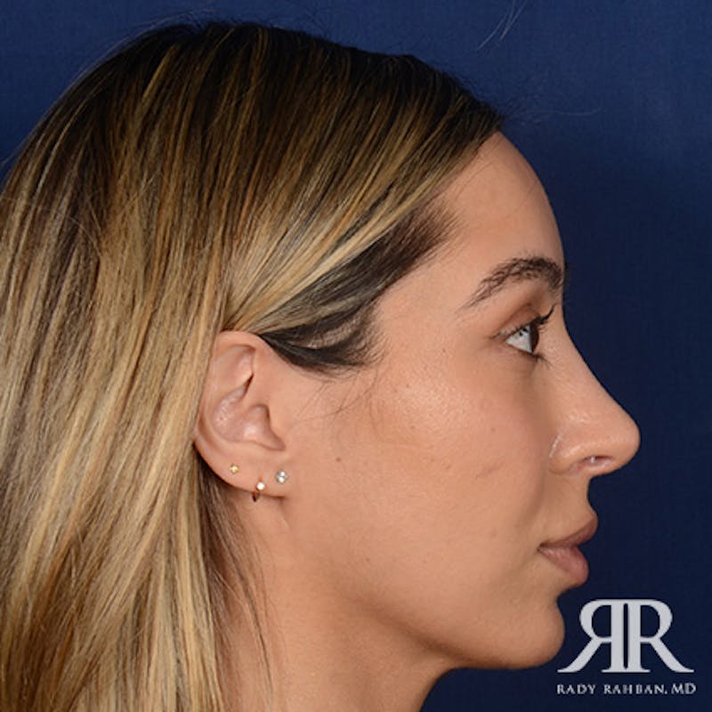 Female Rhinoplasty Before & After Gallery - Patient 916814 - Image 6