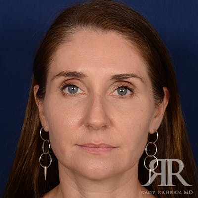 Female Rhinoplasty Before & After Gallery - Patient 118750 - Image 1