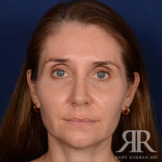 Female Rhinoplasty Before & After Gallery - Patient 118750 - Image 2