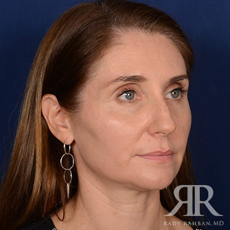 Female Rhinoplasty Before & After Gallery - Patient 118750 - Image 3