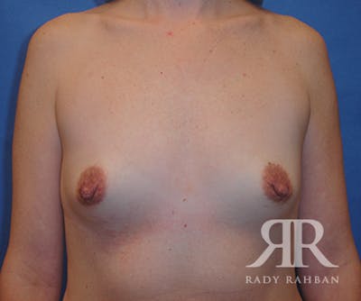 Breast Augmentation Before & After Gallery - Patient 184984 - Image 1