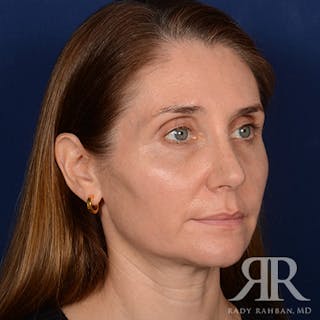 Female Rhinoplasty Before & After Gallery - Patient 118750 - Image 4