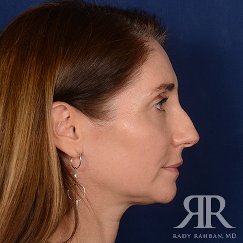 Female Rhinoplasty Before & After Gallery - Patient 118750 - Image 5