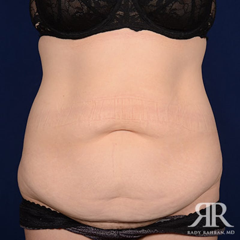Tummy Tuck Before & After Gallery - Patient 307604 - Image 1