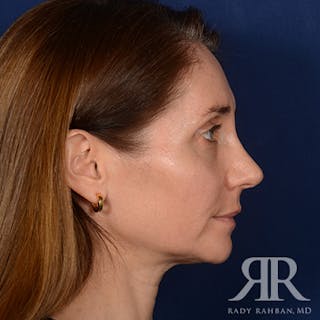 Female Rhinoplasty Before & After Gallery - Patient 118750 - Image 6