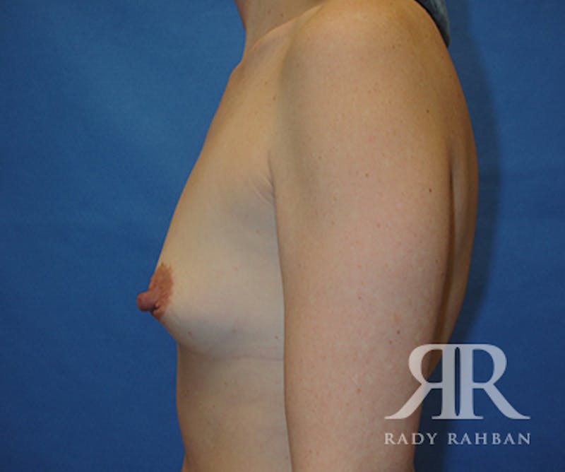 Breast Augmentation Before & After Gallery - Patient 184984 - Image 5