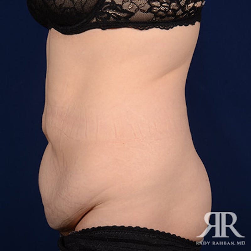 Tummy Tuck Before & After Gallery - Patient 307604 - Image 5