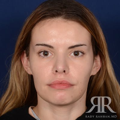 Female Rhinoplasty Before & After Gallery - Patient 194221 - Image 2