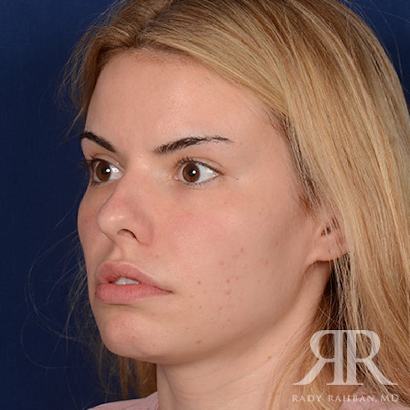 Female Rhinoplasty Before & After Gallery - Patient 194221 - Image 3