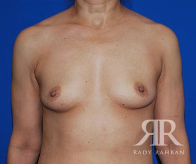 Breast Augmentation Before & After Gallery - Patient 223805 - Image 1