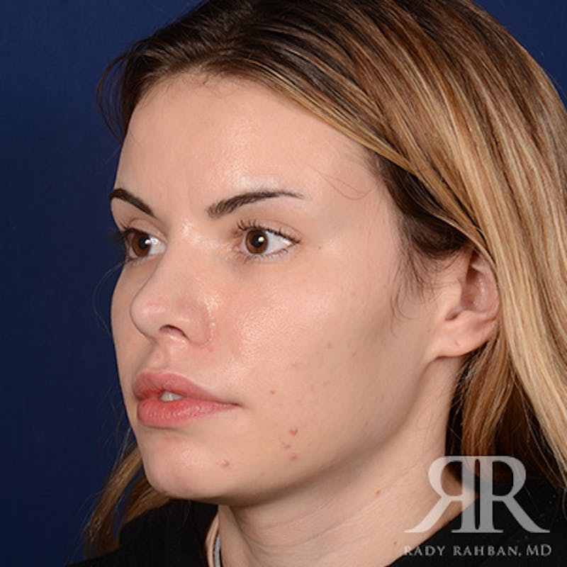 Female Rhinoplasty Before & After Gallery - Patient 194221 - Image 4