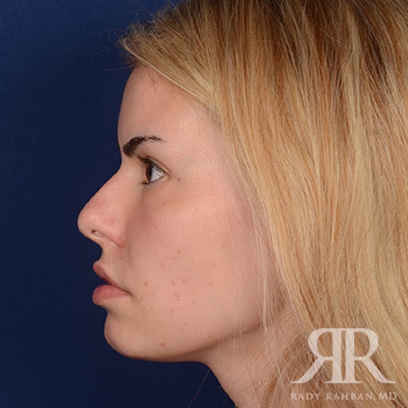 Female Rhinoplasty Before & After Gallery - Patient 194221 - Image 5