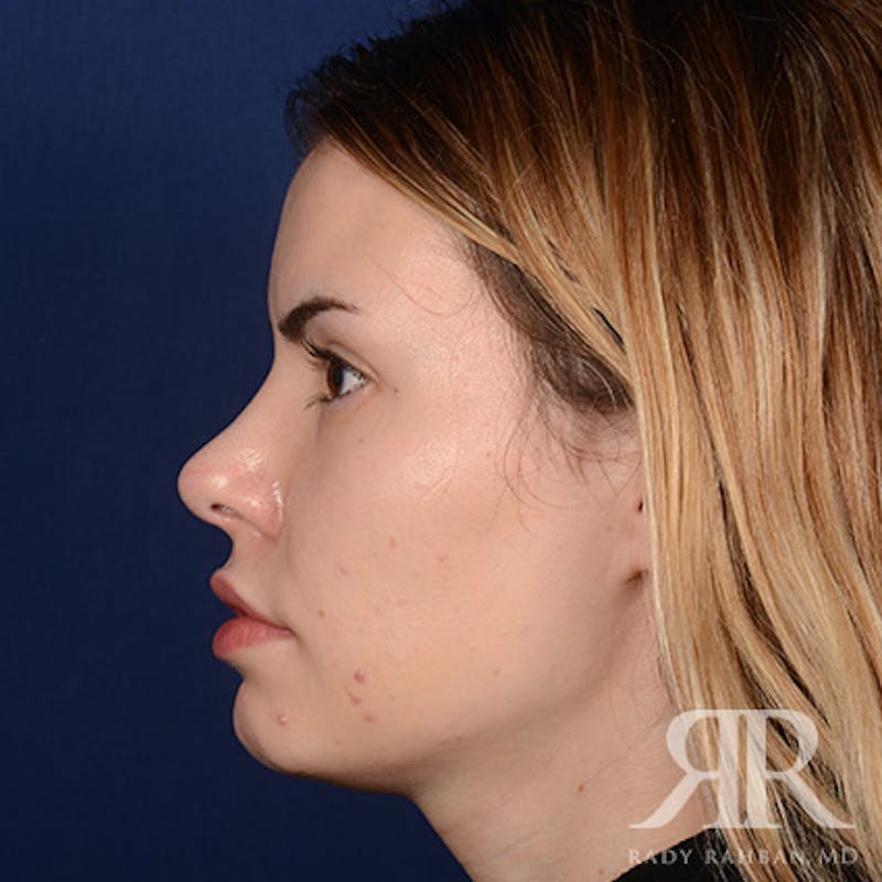 Female Rhinoplasty Before & After Gallery - Patient 194221 - Image 6