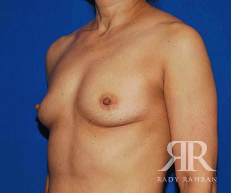 Breast Augmentation Before & After Gallery - Patient 223805 - Image 3