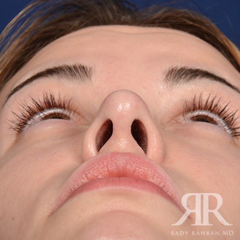 Female Rhinoplasty Before & After Gallery - Patient 194221 - Image 7