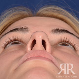 Female Rhinoplasty Before & After Gallery - Patient 194221 - Image 8