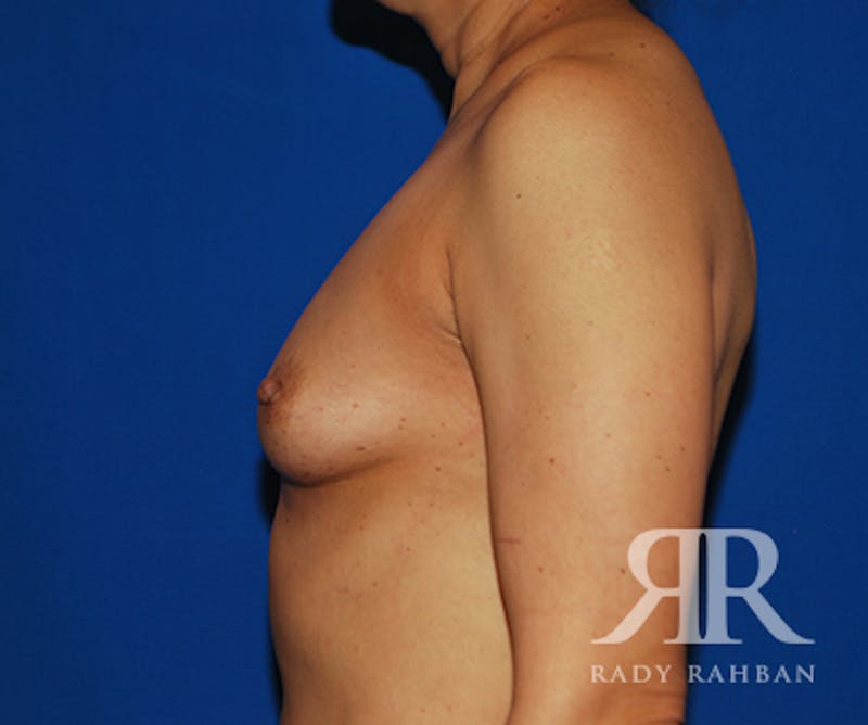 Breast Augmentation Before & After Gallery - Patient 223805 - Image 5