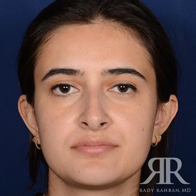 Female Rhinoplasty Before & After Gallery - Patient 396656 - Image 1