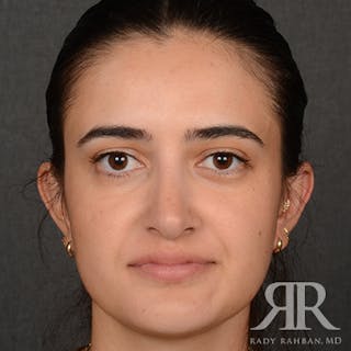 Female Rhinoplasty Before & After Gallery - Patient 396656 - Image 2