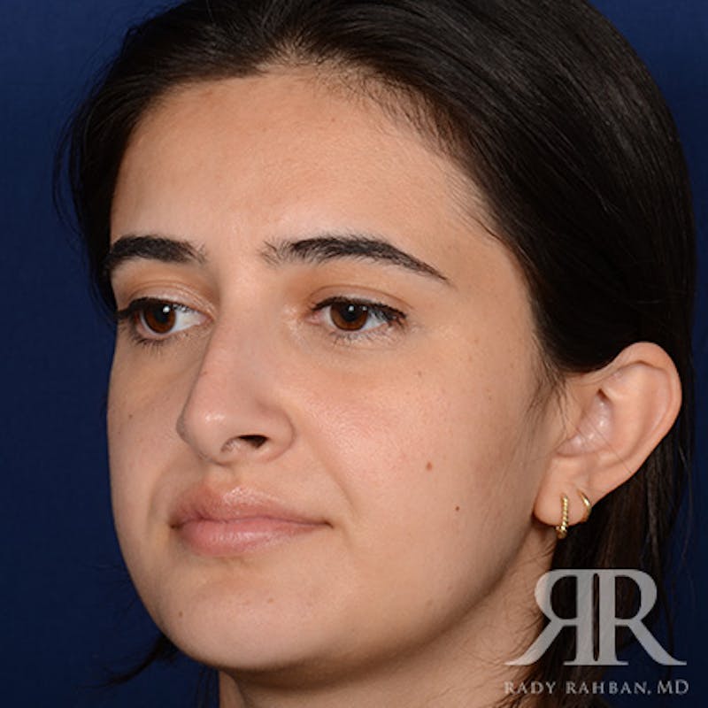 Female Rhinoplasty Before & After Gallery - Patient 396656 - Image 3