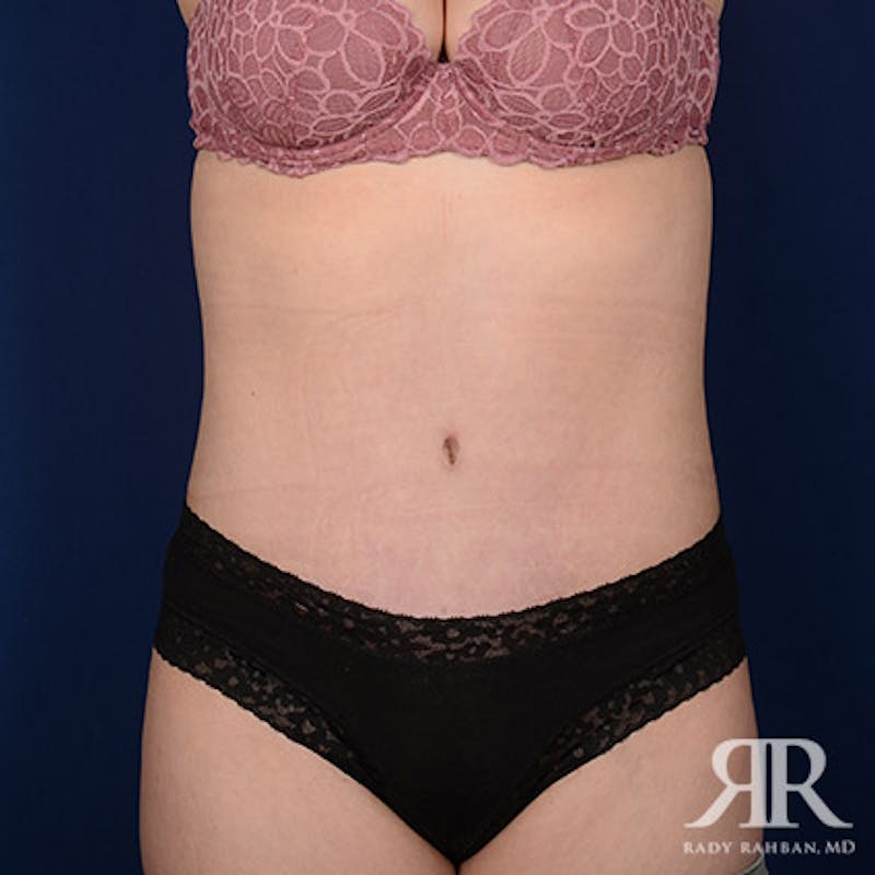 Tummy Tuck Before & After Gallery - Patient 715516 - Image 2