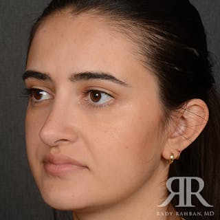 Female Rhinoplasty Before & After Gallery - Patient 396656 - Image 4