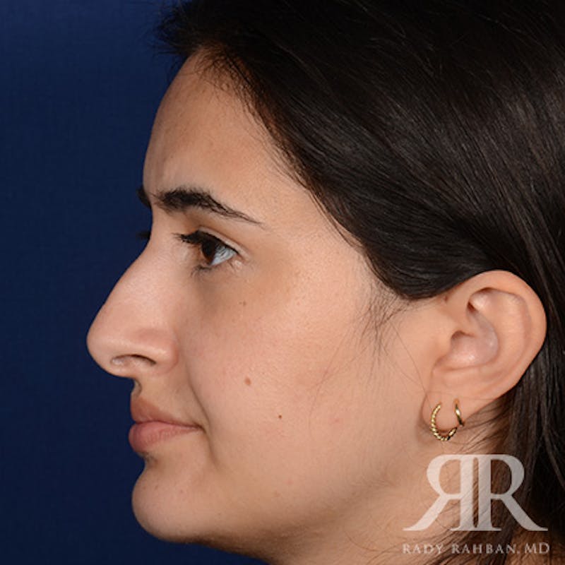 Female Rhinoplasty Before & After Gallery - Patient 396656 - Image 5