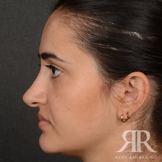 Female Rhinoplasty Before & After Gallery - Patient 396656 - Image 6