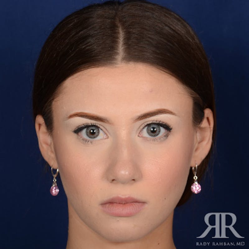 Female Rhinoplasty Before & After Gallery - Patient 124495 - Image 1