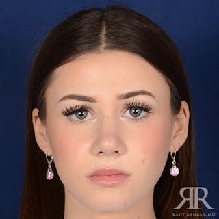 Female Rhinoplasty Before & After Gallery - Patient 124495 - Image 2