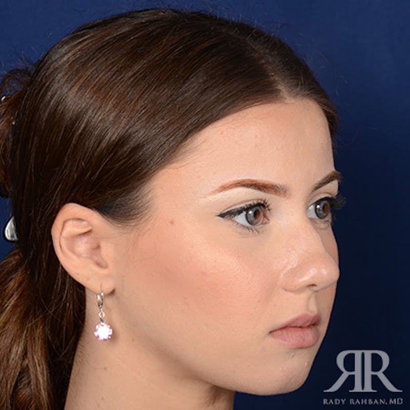 Female Rhinoplasty Before & After Gallery - Patient 124495 - Image 3
