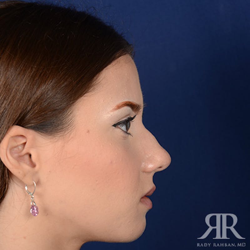 Female Rhinoplasty Before & After Gallery - Patient 124495 - Image 5