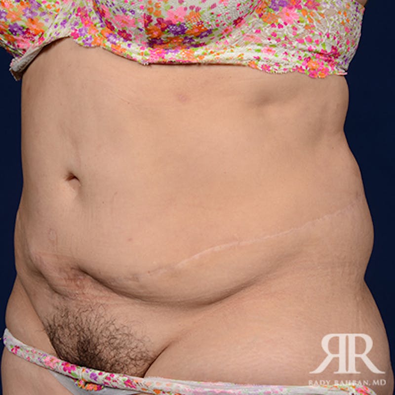 Tummy Tuck Before & After Gallery - Patient 497514 - Image 3