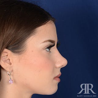 Female Rhinoplasty Before & After Gallery - Patient 124495 - Image 6