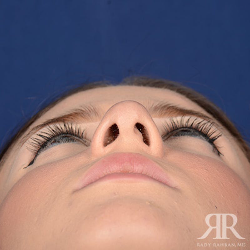 Female Rhinoplasty Before & After Gallery - Patient 124495 - Image 7