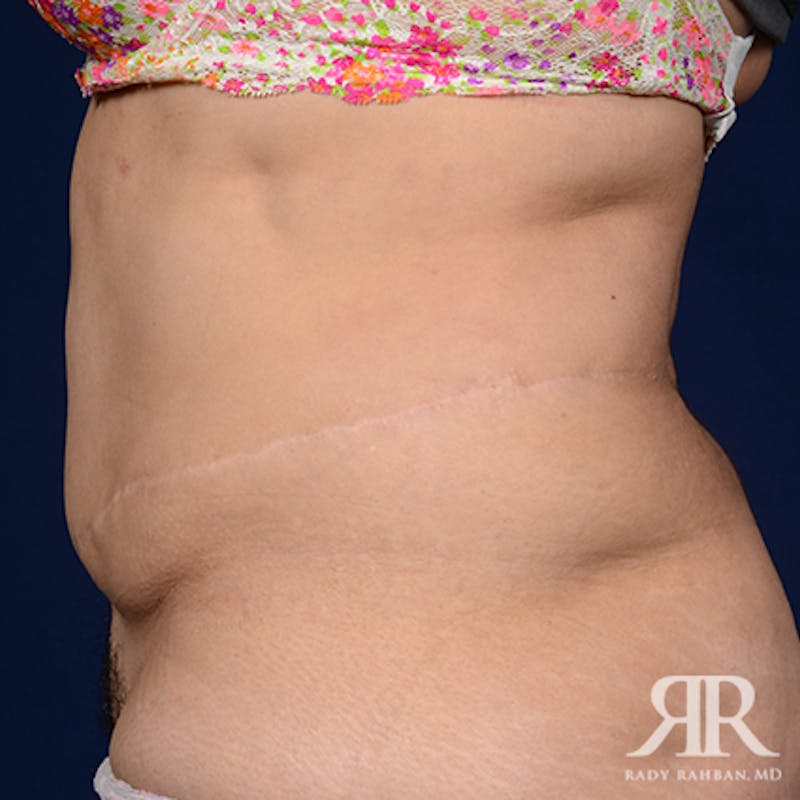 Tummy Tuck Before & After Gallery - Patient 497514 - Image 5