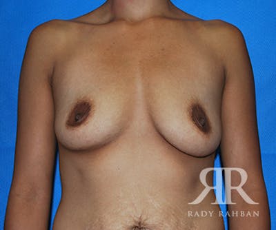 Breast Augmentation Before & After Gallery - Patient 118983 - Image 1