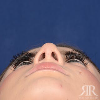 Female Rhinoplasty Before & After Gallery - Patient 124495 - Image 8