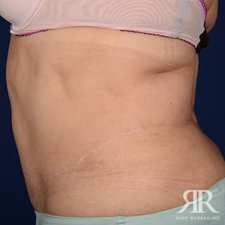 Tummy Tuck Before & After Gallery - Patient 497514 - Image 6