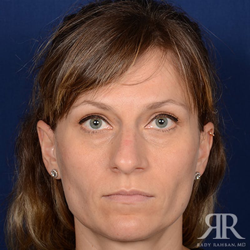 Female Rhinoplasty Before & After Gallery - Patient 994367 - Image 1