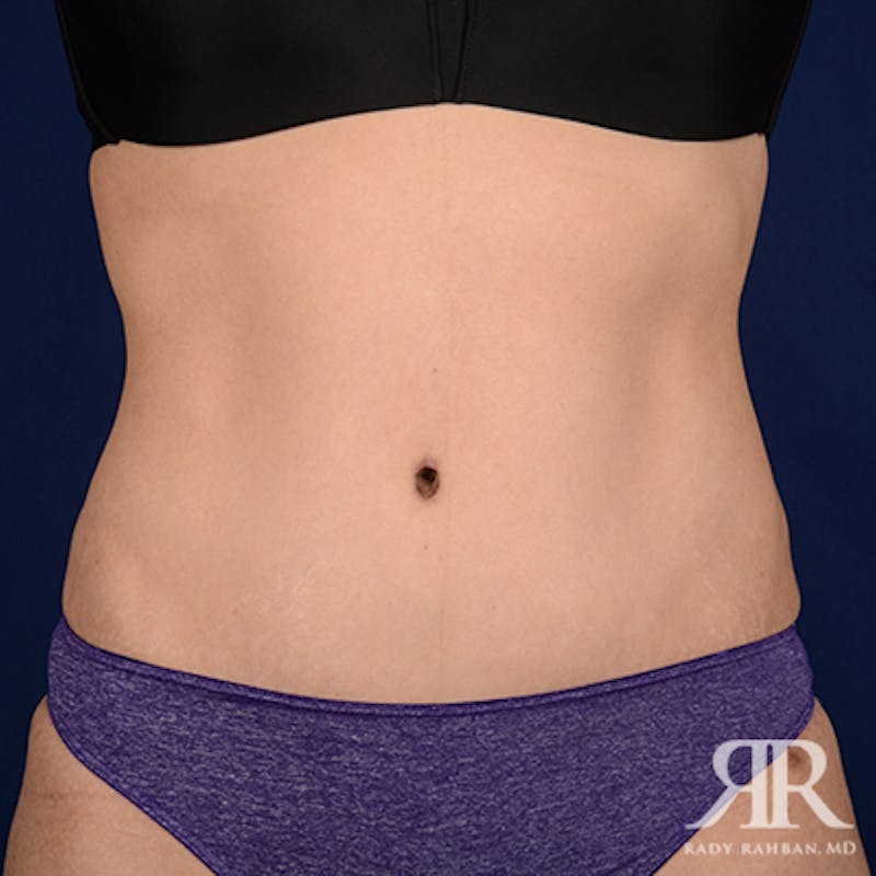 Tummy Tuck Before & After Gallery - Patient 162116 - Image 2