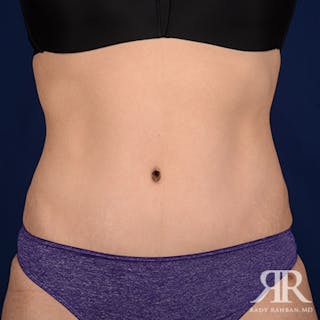 Tummy Tuck Before & After Gallery - Patient 162116 - Image 2