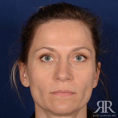 Female Rhinoplasty Before & After Gallery - Patient 994367 - Image 2