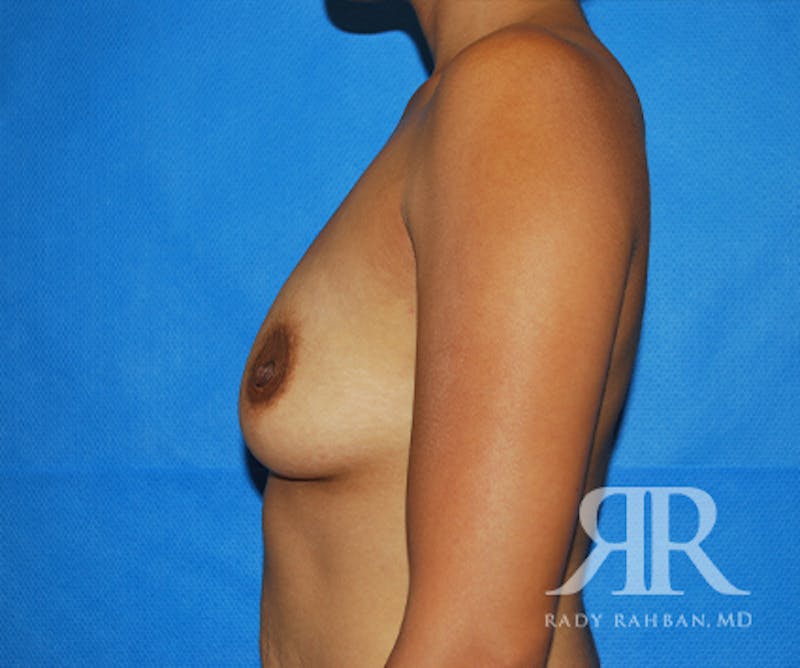 Breast Augmentation Before & After Gallery - Patient 118983 - Image 5